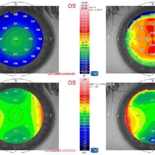 LE The preoperative corneal tomography shows compound myopic ...