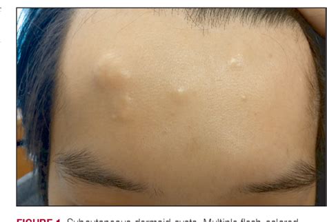 Dermoid Cyst Forehead