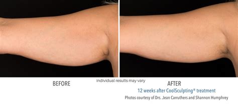 Cool Sculpting Before And After Fat Freezing Results