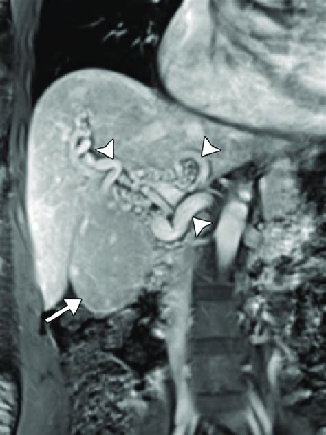 Hereditary Hemorrhagic Telangiectasia HHT In A 48 Year Old Woman