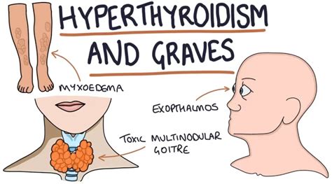 Hyperthyroidism In Men Archives Samarpan Physiotherapy Clinic Ahmedabad