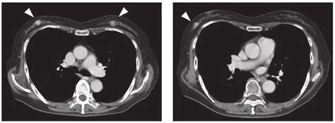 Contrast Enhanced Computed Tomography Ct A Ct Scans Revealed