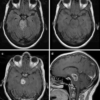 MRI imaging of non-DIPG case 13. The tumor origin is nearly completely... | Download Scientific ...