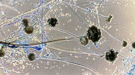 Mucormycosis (The black fungus infection): Causal agents and their morphology, Pathogenesis ...