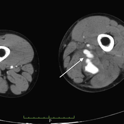 CT Scan Showing Major Oedema Of Lower Left Limb And Arteriovenous