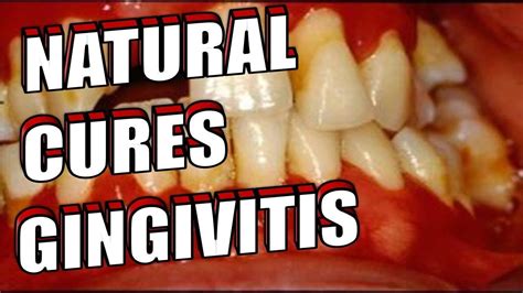 How To Get Rid Of GINGIVITIS At Home NATURALLY EASILY Gum Disease