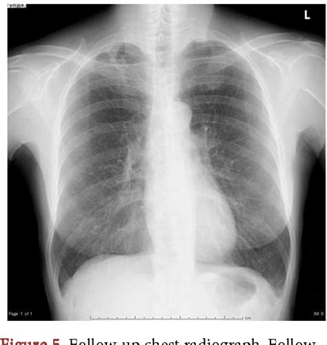 Figure 5 from Pseudomonas aeruginosa Community Acquired Pneumonia with ...