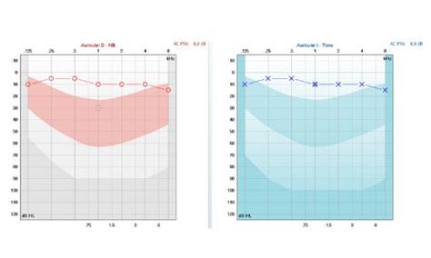 El Audiograma Curva Del Umbral De Audici N Biacustic