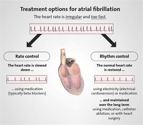 Atrial Fibrillation Learn More How Can An Irregular Heart Rhythm Be