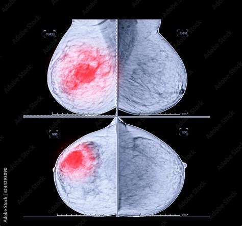 Foto De X Ray Digital Mammogram Both Side Cc View And Mlo Mammography