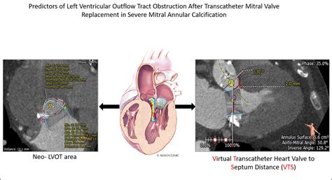 Predictors Of Left Ventricular Outflow Tract Obstruction After