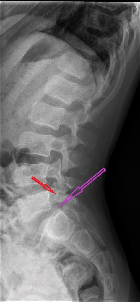 Spondylolisthese L5s1 Pregnancy Depression