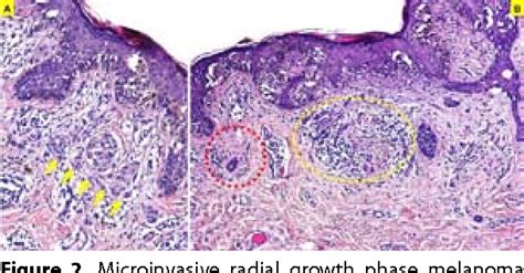 Figure 2 From Microinvasive Radial Growth Phase Of Cutaneous Melanoma