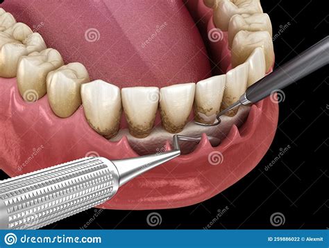 Open Curettage Scaling And Root Planing Conventional Periodontal