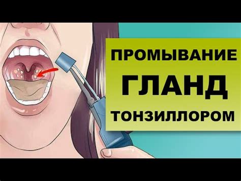 ПРОМЫВАНИЕ ГЛАНД ТОНЗИЛЛОРОМ - YouTube