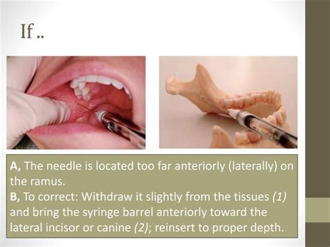 Mandibular Anesthesia Inferior Alveolar Nerve Block Ppt