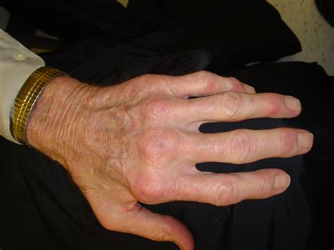 Defining Difficult Rheumatoid Arthritis | RheumNow