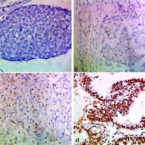 The Immunohistochemical Expression Of Gata In Study Cases Of Different