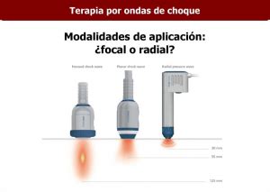 Realmente me están aplicando Ondas de Choque Fisioterapia Sei Herri