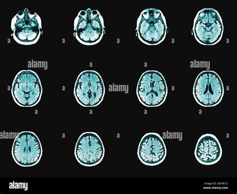 Conjunto de imágenes de tomografía computarizada de cabeza y cerebro