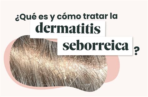 Qué es y cómo tratar la dermatitis seborreica