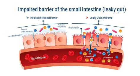 What Is A Leaky Gut – NBKomputer