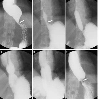 Pdf Esophageal Achalasia Comparison Of Fluoroscopically Guided