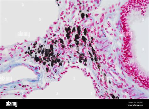 Smoker S Lung Light Micrograph Stock Photo Alamy