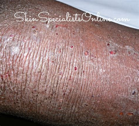 Papular Pruritic Eruption PPE - Skin Specialists Online