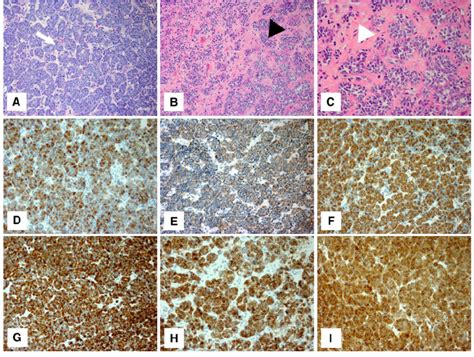 Morphological And Immunohistochemical Features Of Leiomyomatoid