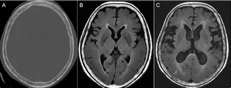 Figure From Multiple Myeloma With Intracranial And Spinal Intradural