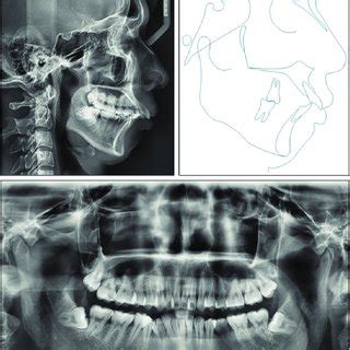 Total Distalization Of Mandibular Arch With Buccal Shelf Miniscrew