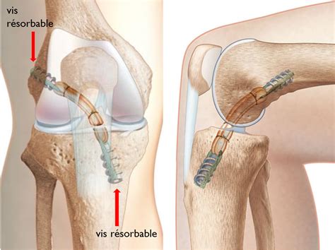 Ligamento Cruzado Dr R Mi Chirurgien Orthop Diste Toulouse