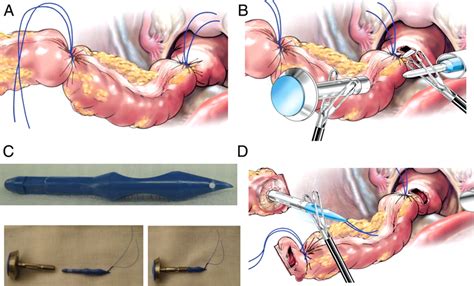 Technique For Full Laparoscopic Sigmoid Resection A The Specimen Is Download Scientific