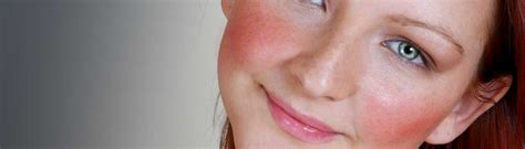 Rosacea Total Skin Center