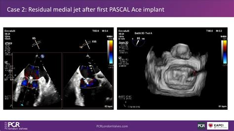 Advancing Valve Repair Mastering Diverse Mitral And Tricuspid