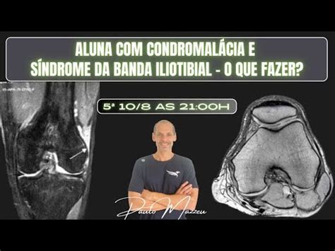 Aluna Condromal Cia E S Ndrome Da Banda Iliotibial O Que Fazer