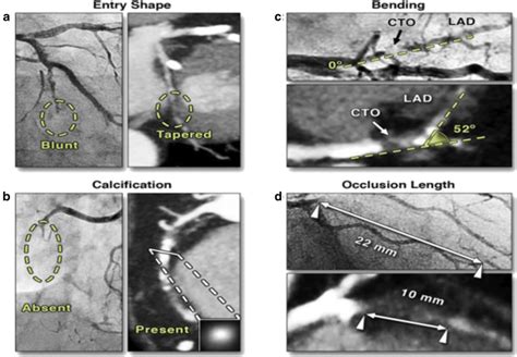 Cto Characteristics By Coronary Angiography Versus Ccta A Conventional