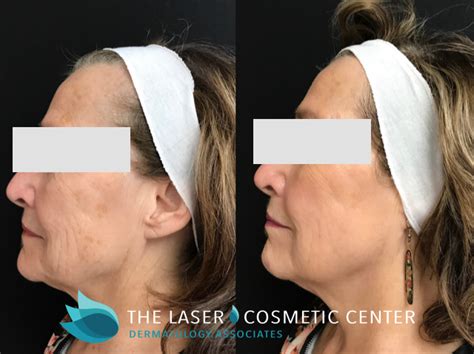 Fraxel Dual Laser Cosmetic Center