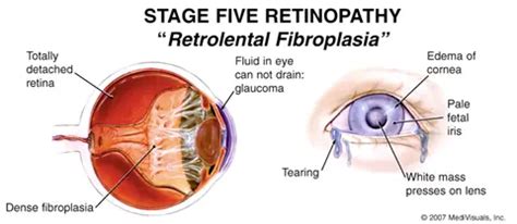 Retinopathy Of Prematurity Rop Gulf Coast Alabama And Florida