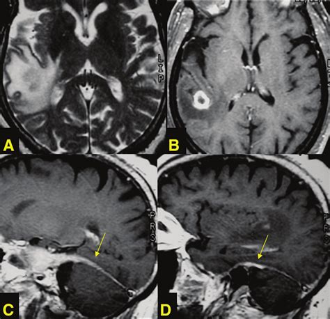 Neurosyphilis A 52 Year Old Man With High Risk Behavior Presented With