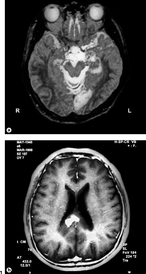 Figure From Posterior Cerebral Artery Infarction Caused By Cerebral