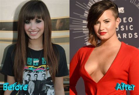 Demi Lovato Plastic Surgery: An Improvement For A Young Star