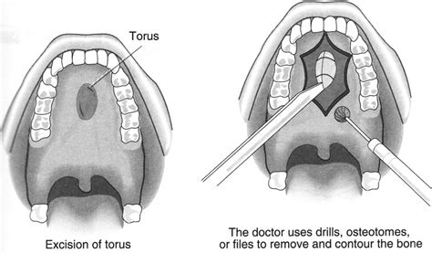 Mandibular torus - ENT Clinic