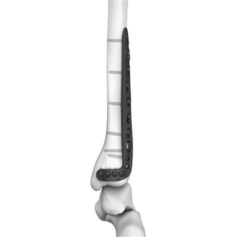 Tibia Compression Plate Series Boneunion Medical Distal