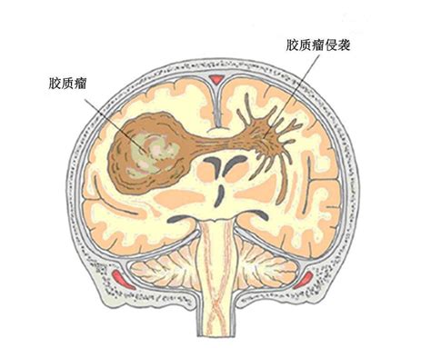 脑胶质瘤治愈率？胶质瘤能活多久 哔哩哔哩