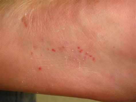 Superdrug Health Clinic Types Of Bacterial Skin Infections