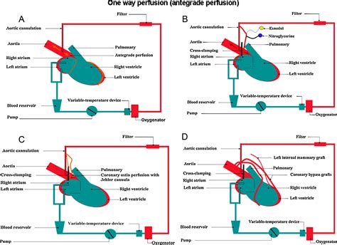 On Pump Beating Heart Surgery Heart Lung And Circulation