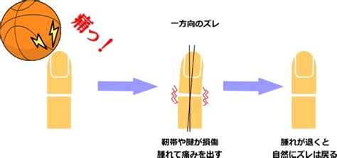 突き指は放っておいても治る？応急処置から後遺症になるメカニズムまで徹底解説突き指の治療と応急処置 神戸・明石・三木・加古川 はりま接骨院