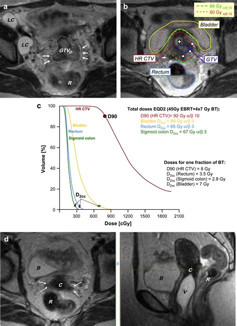 Image Guided Adaptive Brachytherapy For Cervix Carcinoma Clinical Oncology